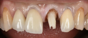 薄く折れやすい状態の前歯を、予知性の高いインプラントで治療した症例【前歯部審美症例11】